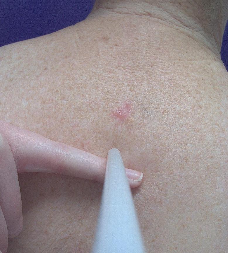 Clinical photo of basal cell carcinoma