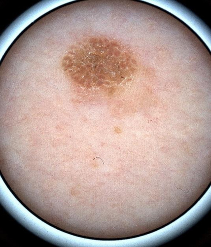 Clinical photo of seborrhoeic keratosis
