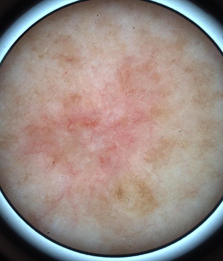 Dermoscopy of basal cell carcinoma