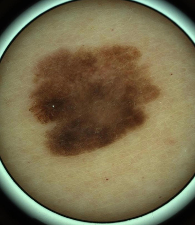 Dermoscopy of melanoma