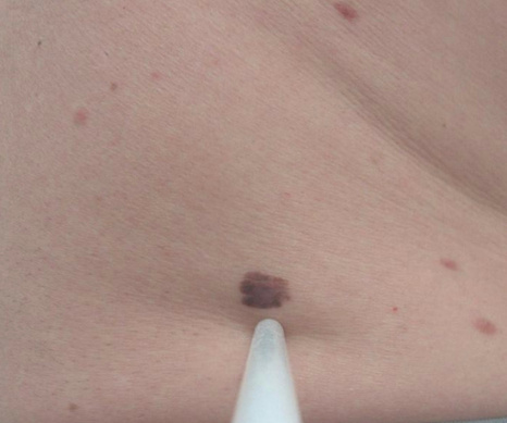 Clinical photo of melanoma