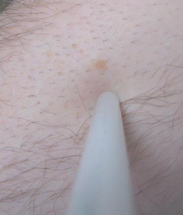 Clinical photo of benign melanocytic naevus